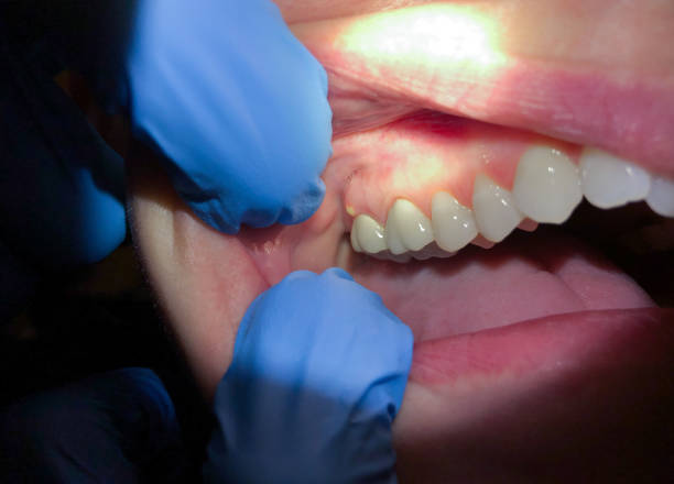 Best Emergency Dentist for Lost Fillings or Crowns in Stow, OH